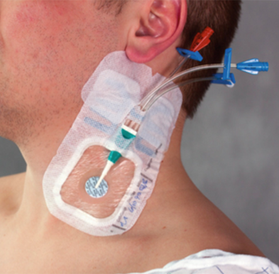 Central Venous Catheter